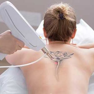 tattoo removal milton keynes tattoo removal Milton Keynes clinic using Q‑Switch laser – ink lightening process