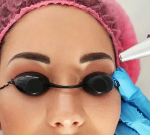 Permanent makeup eyebrow removal with Nd:YAG laser at Art Laser Clinic Milton Keynes