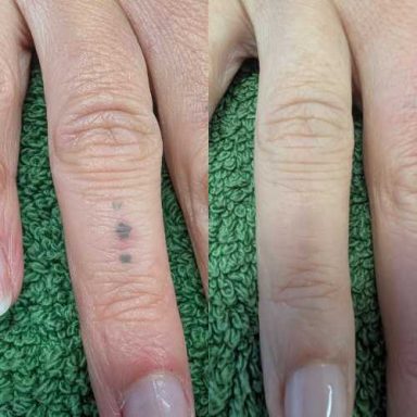 Tattoo Removal Milton Keynes